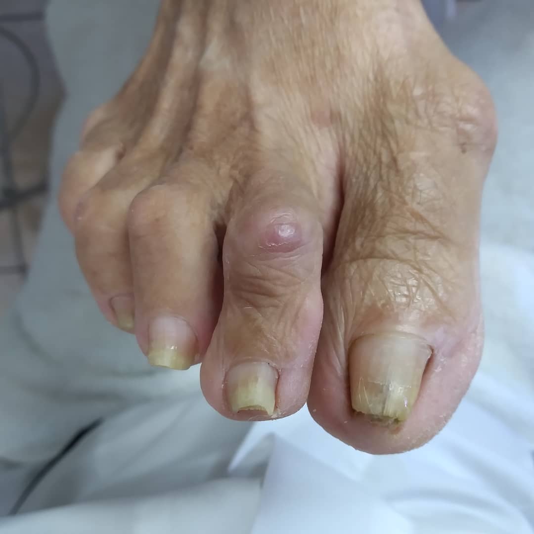 Pés com unhas encravadas Imagem Podóloga Drica Taise