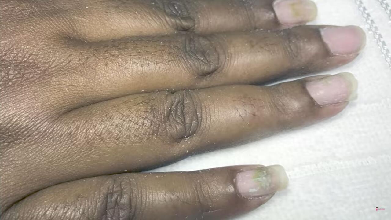 Unhas com fungos após alongamento 