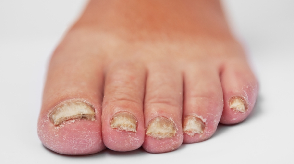 Unhas dos pés com infecção fúngica avançada 