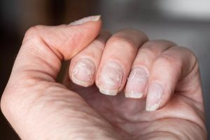 Como ressuscitar unhas quebradiças: veja dicas e opções de bases fortalecedoras